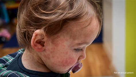 Measles: symptoms and signs - Merck.com