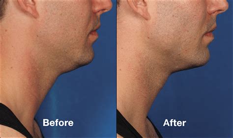 KYBELLA Injectable Double Chin Reduction Before After Photos | Atlanta ...