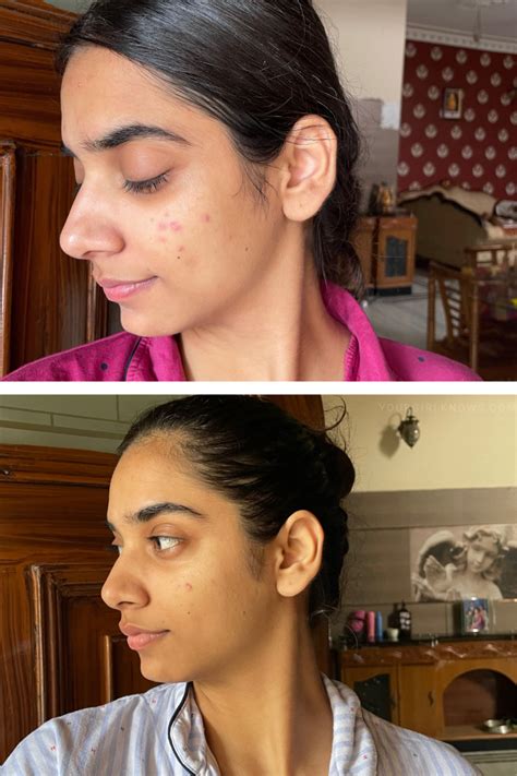 11 The Ordinary Products For Acne Scars That CHANGED My Skin