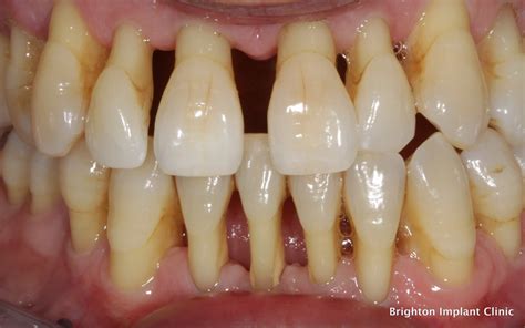 What Causes Periodontal or Gum Disease?