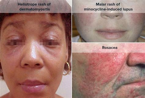 Lupus Malar Rash Vs Rosacea