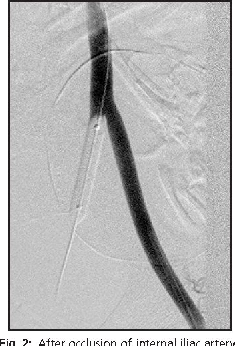 Figure 1 from Prophylactic bilateral internal iliac artery balloon ...