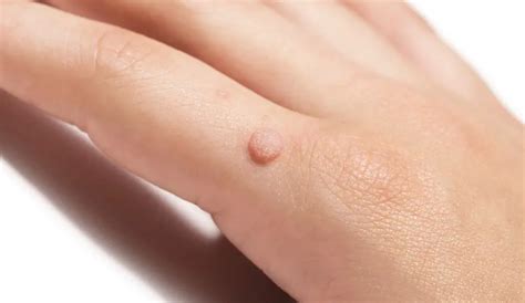 Expert Wart Removal Services in Adelaide - Safe and Effective Treatments