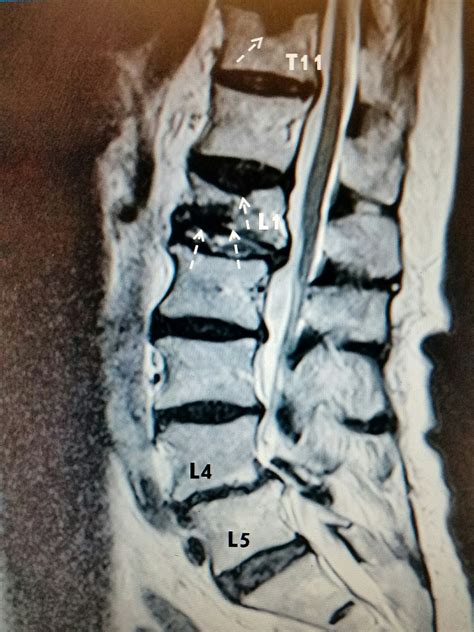 Cureus | Delayed Recognition of Thoracic and Lumbar Vertebral ...