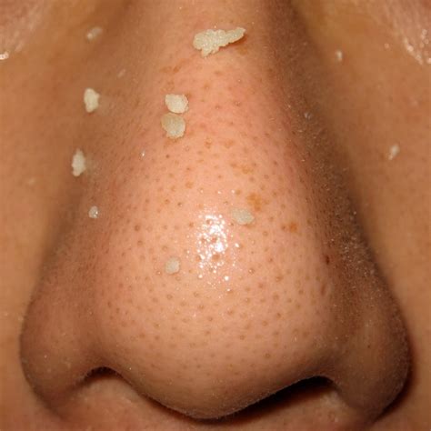 3 Proven Tips on How to Get Rid of Blackheads on Your Nose | Tips Zone