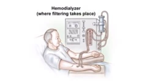 Dialysis Access and Fistula Procedure - YouTube