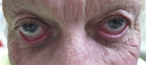Ectropion eye definition, causes, symptoms, diagnosis, treatment & surgery