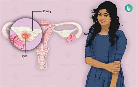 Ovary Cyst Medication