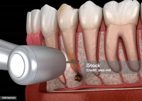 Tooth Cystectomy Surgery Recovery After Periostitis Dental 3d Illustration Stock Photo ...