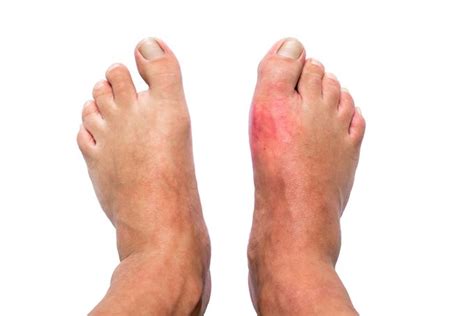 Bunion vs. Gout: What Is the Difference? - Upstep Answers