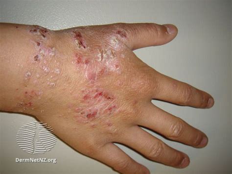 Skin Allergy Types, Causes, and Treatments