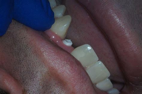 Zirconia Abutments and When to Use Them - Spear Education