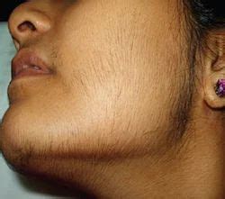 Hirsutism - Dr. Walia's Skin And Laser Clinic 030