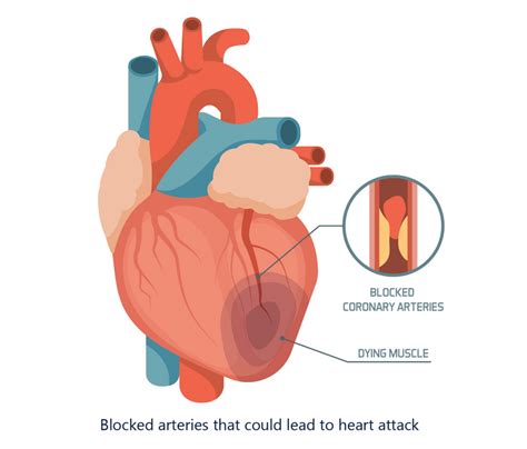 What does a heart attack feel like: symptoms and warning signs • HRI