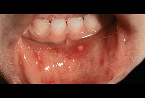 Hand, Foot, and Mouth disease and Herpangina - Bebout Family Medicine