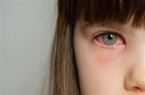 Pink Eye vs. Stye: How to Tell the Difference?