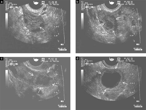 Form and function of the corpus luteum during the human menstrual cycle - Baerwald - 2005 ...