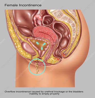 Overflow Incontinence in Female Anatomy - Stock Image - F031/7012 - Science Photo Library