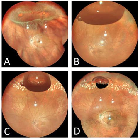 Retinal Detachment Treatment