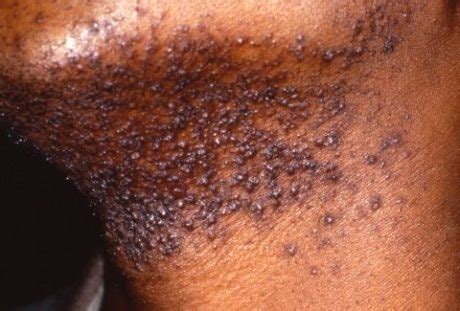 What Causes Razor Burn? [+5 Remedies & Treatments] - Shave.net