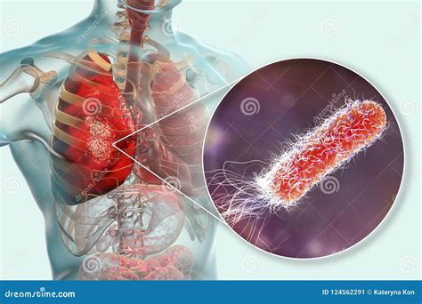 Lung Infection Caused By Bacteria Pseudomonas Aeruginosa Royalty-Free Cartoon | CartoonDealer ...