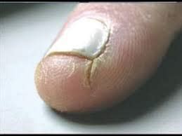 Causes and Treatments of Skin Around Nails Cracking | New Health Advisor