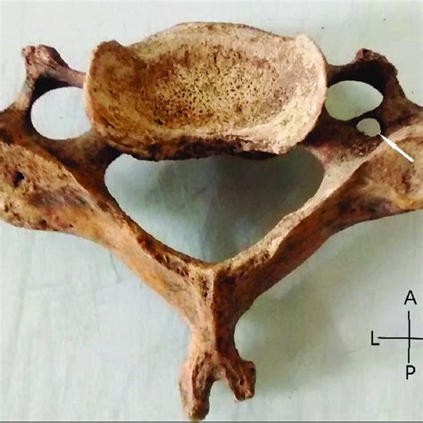 Arrow showing unilateral accessory foramen transversarium on right side... | Download Scientific ...