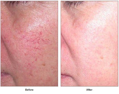 Laser Spider Vein Removal in Santa Rosa and Healdsburg