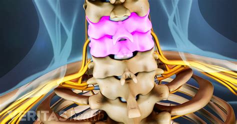 Anterior Cervical Discectomy and Fusion Complications