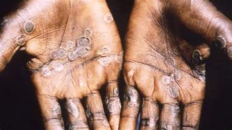 UK health care worker contracts rare monkeypox virus in third case ...