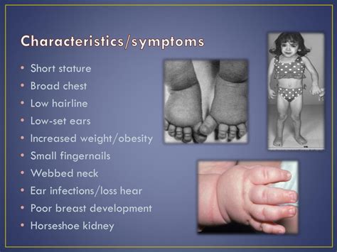 PPT - Turner Syndrome PowerPoint Presentation, free download - ID:2600553