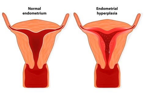 Menorrhagia: Menstrual Disorder in women - ReliableRxPharmacy Blog, Health Blog