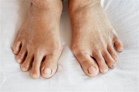 Early Signs of Arthritis in Feet