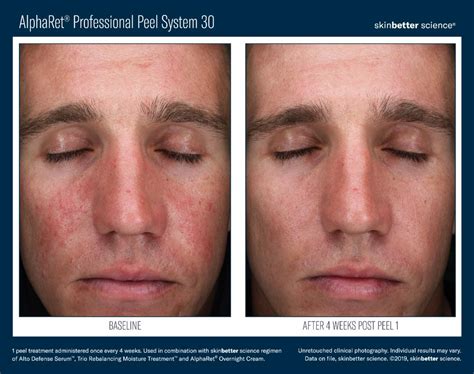 SkinBetter Science Chemical Peel Day (July 20, 2021) – Arlington Skin Doctor