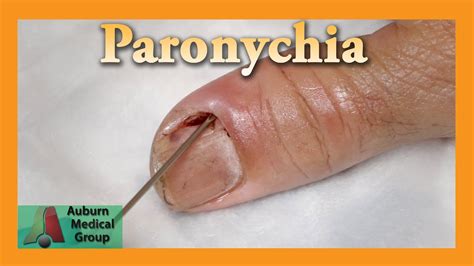 Paronychia Drainage Technique