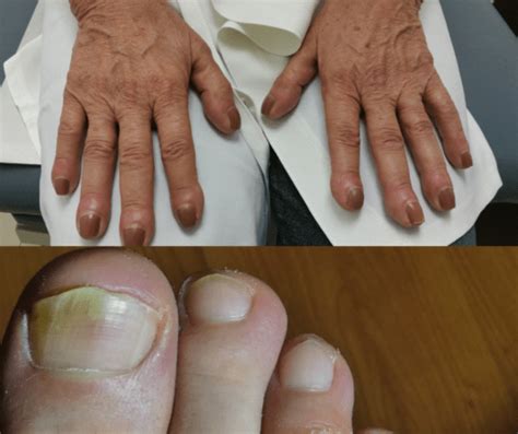 Does Kidney Disease nails cause problems with nails ? - %sit