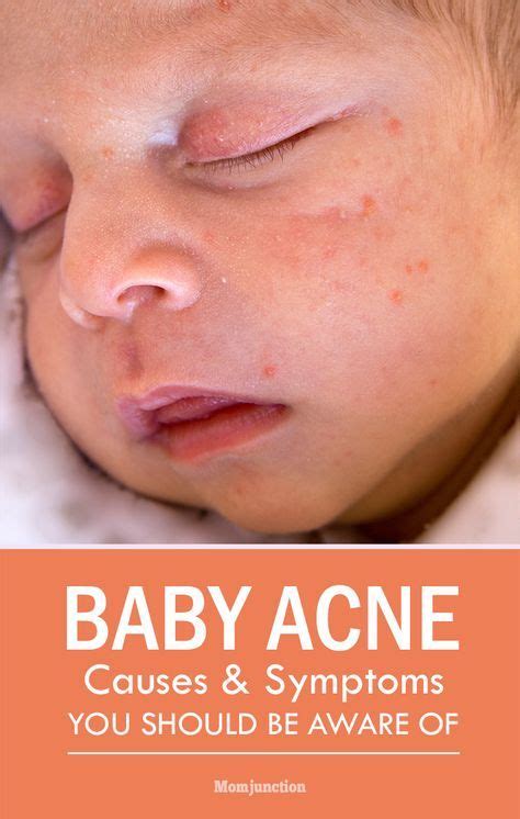 Treatment Of Acne In Kids - LiamWhinham