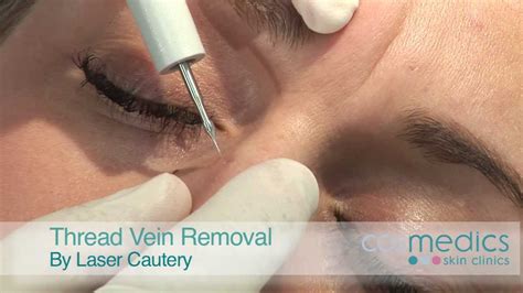 Thread Vein Removal on Face by Laser - London - YouTube