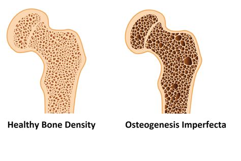 Osteogenesis Imperfecta | News | Dentagama