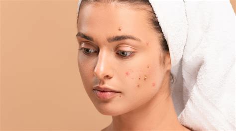 Acne: Causes, Types, and Treatments | Sozo Clinic