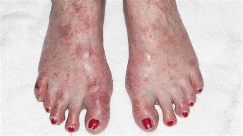 Dyshidrotic Eczema Feet