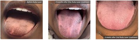 Black spots on tongue and pigmentation in NYC | Ruby Laser Resurfacing