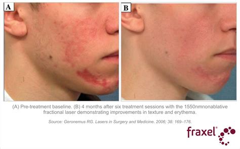 Fraxel Results - Fraxel