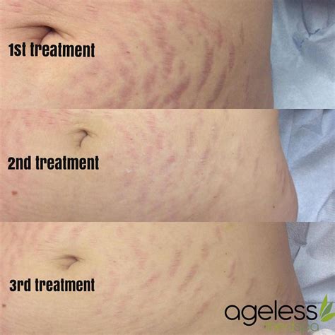 Laser Stretch Mark Removal – Does It Really Work?