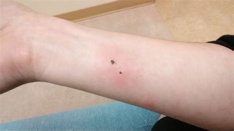 I got bit by a brown spider - taylorfess