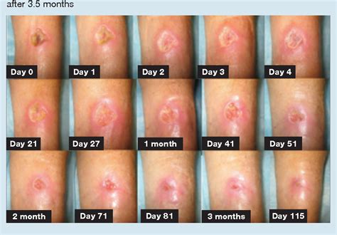 Healing of an arterial leg ulcer by compression bandaging: a case ...