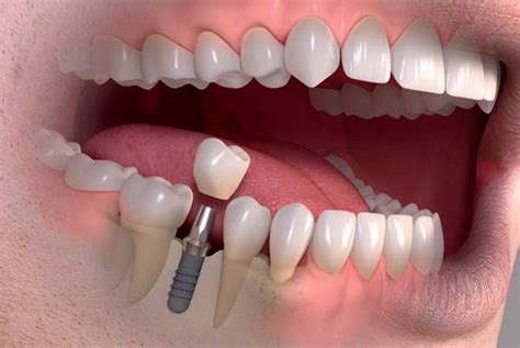 O que devo saber sobre os Tipos de implantes dentários? - Laser Odonto