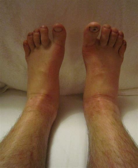 Causes of MILD vs. Severe Bilateral Ankle Swelling » Scary Symptoms