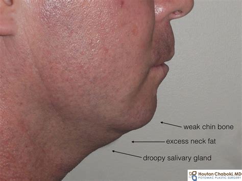 Double Chin Treatment: Which Surgery Is Best? (Before and After Photos ...