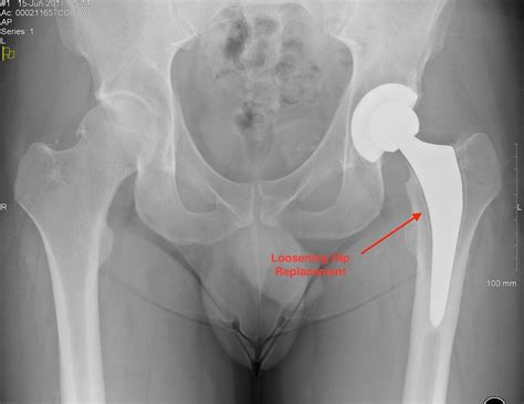 Complications Hip Surgery – Knee and Hip Website